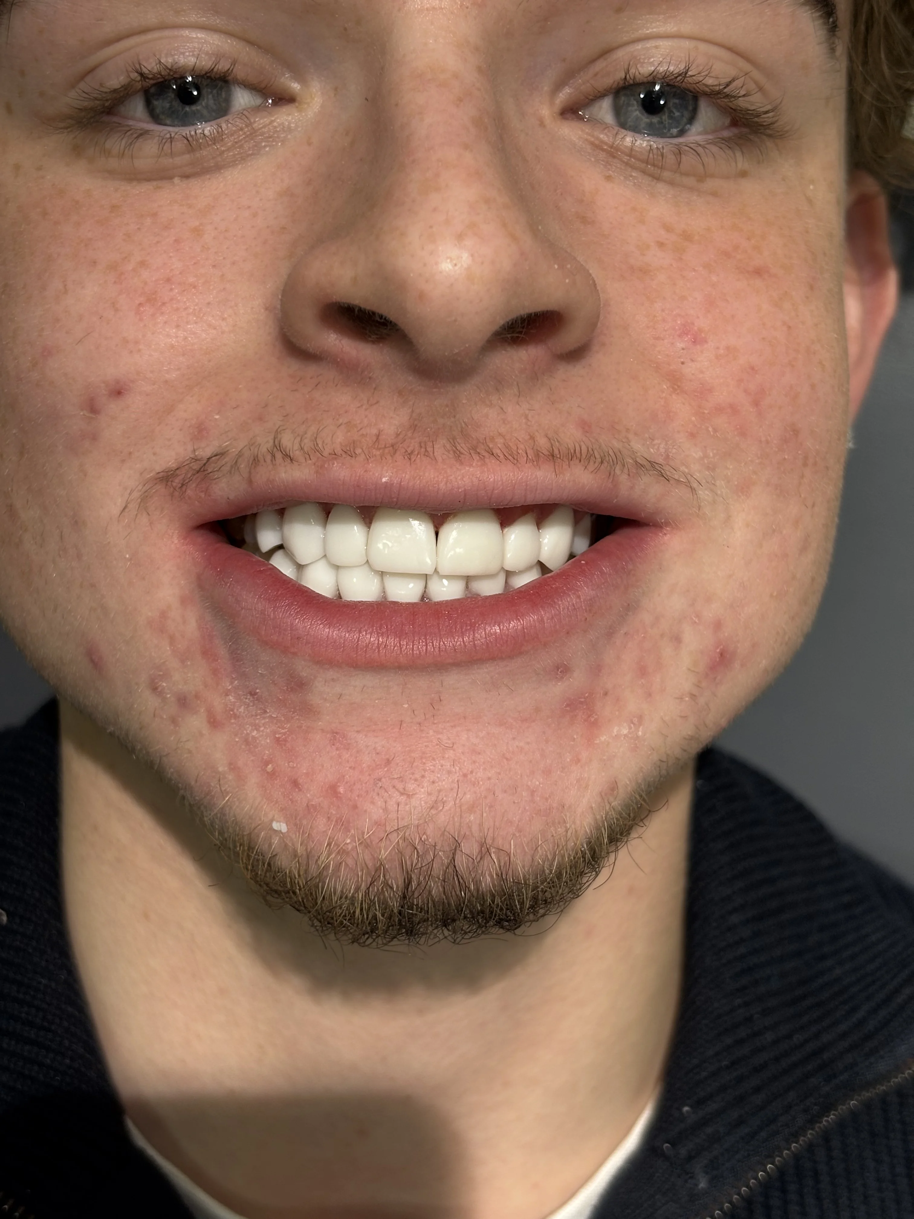 Composite bonding after case 15 — Istanbul NexWell