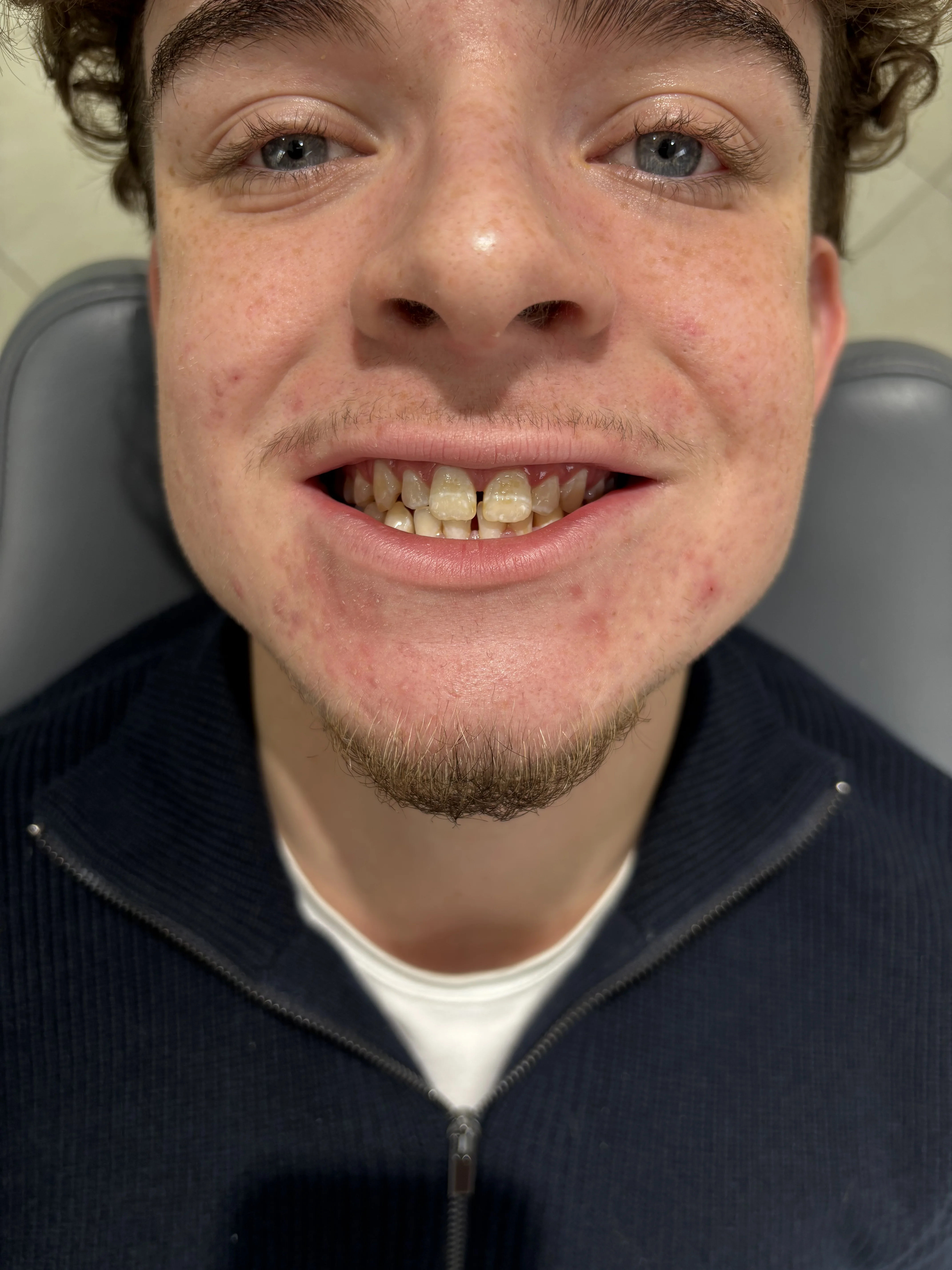 Composite bonding before case 15 — Istanbul