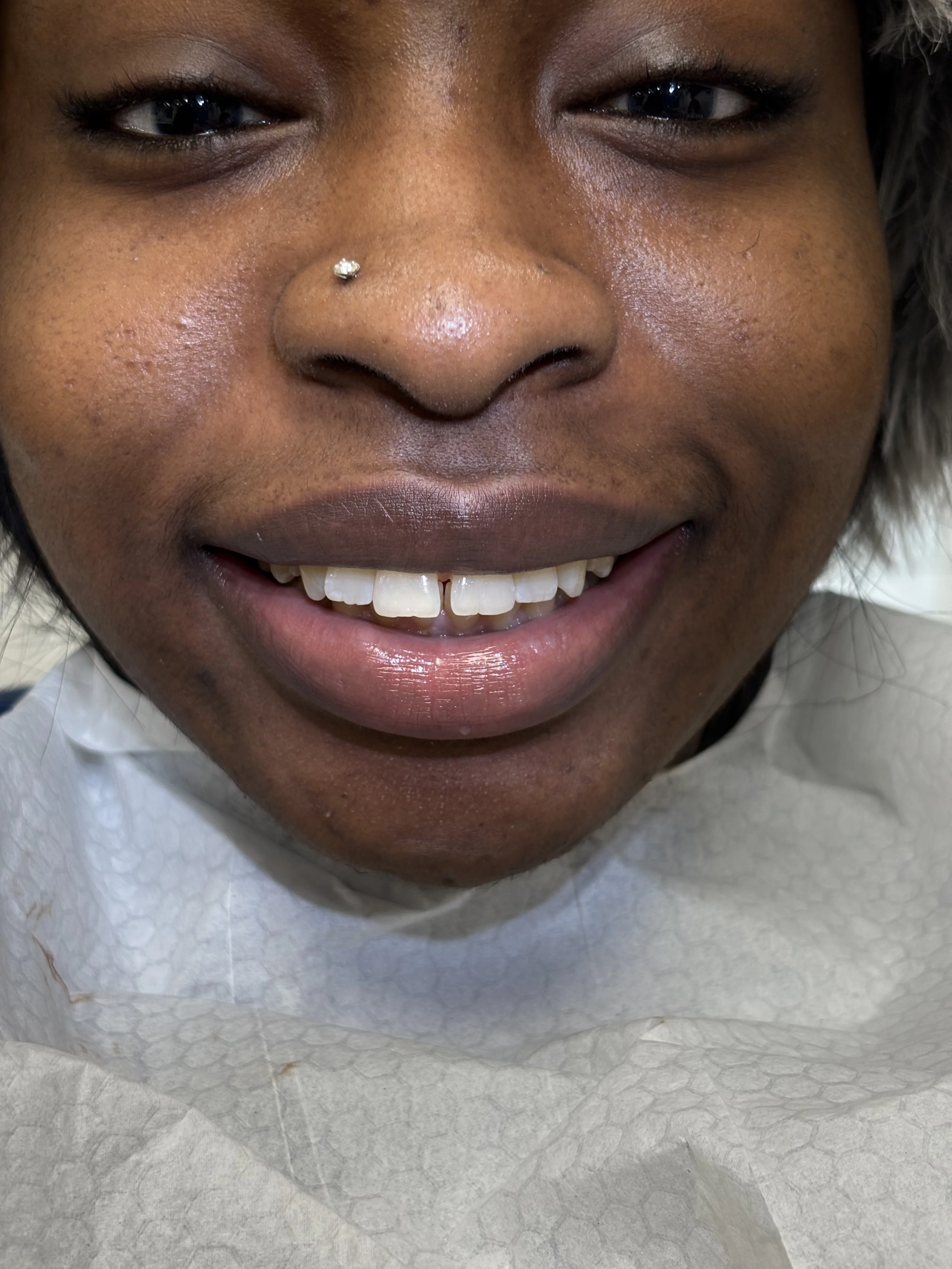 Composite bonding before case 16 — Istanbul