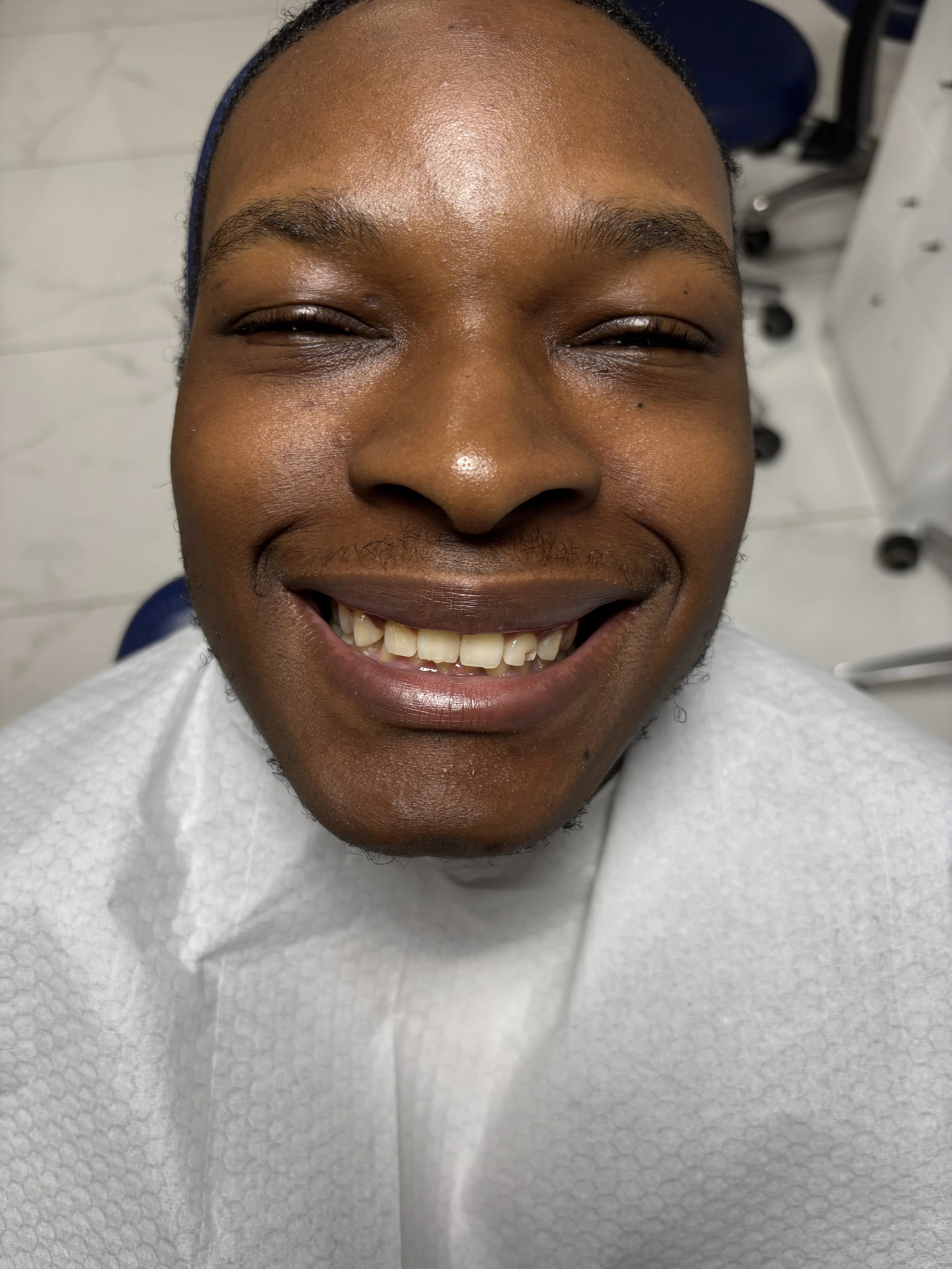 Composite bonding before case 17 — Istanbul