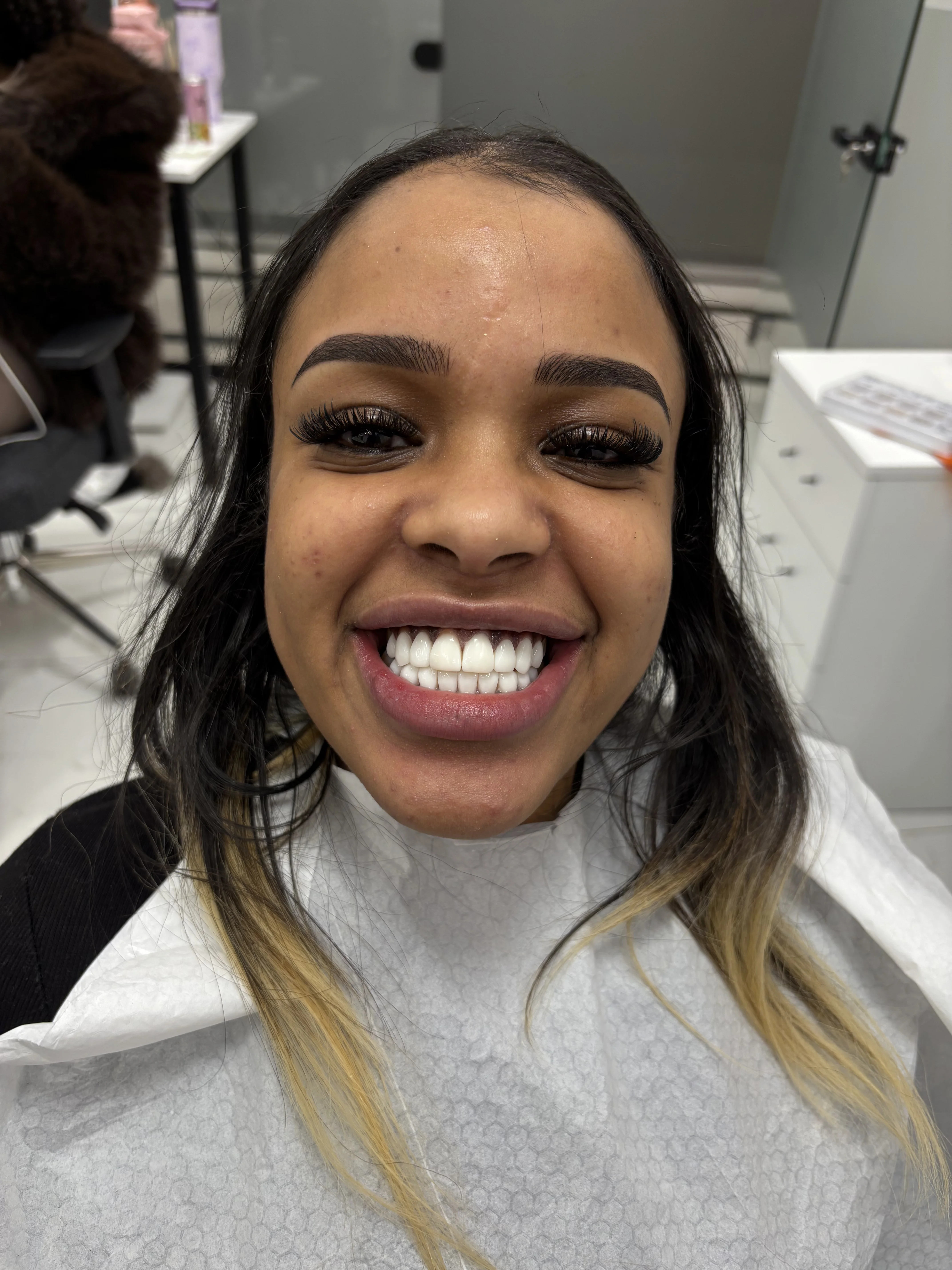 Composite bonding after case 18 — Istanbul NexWell
