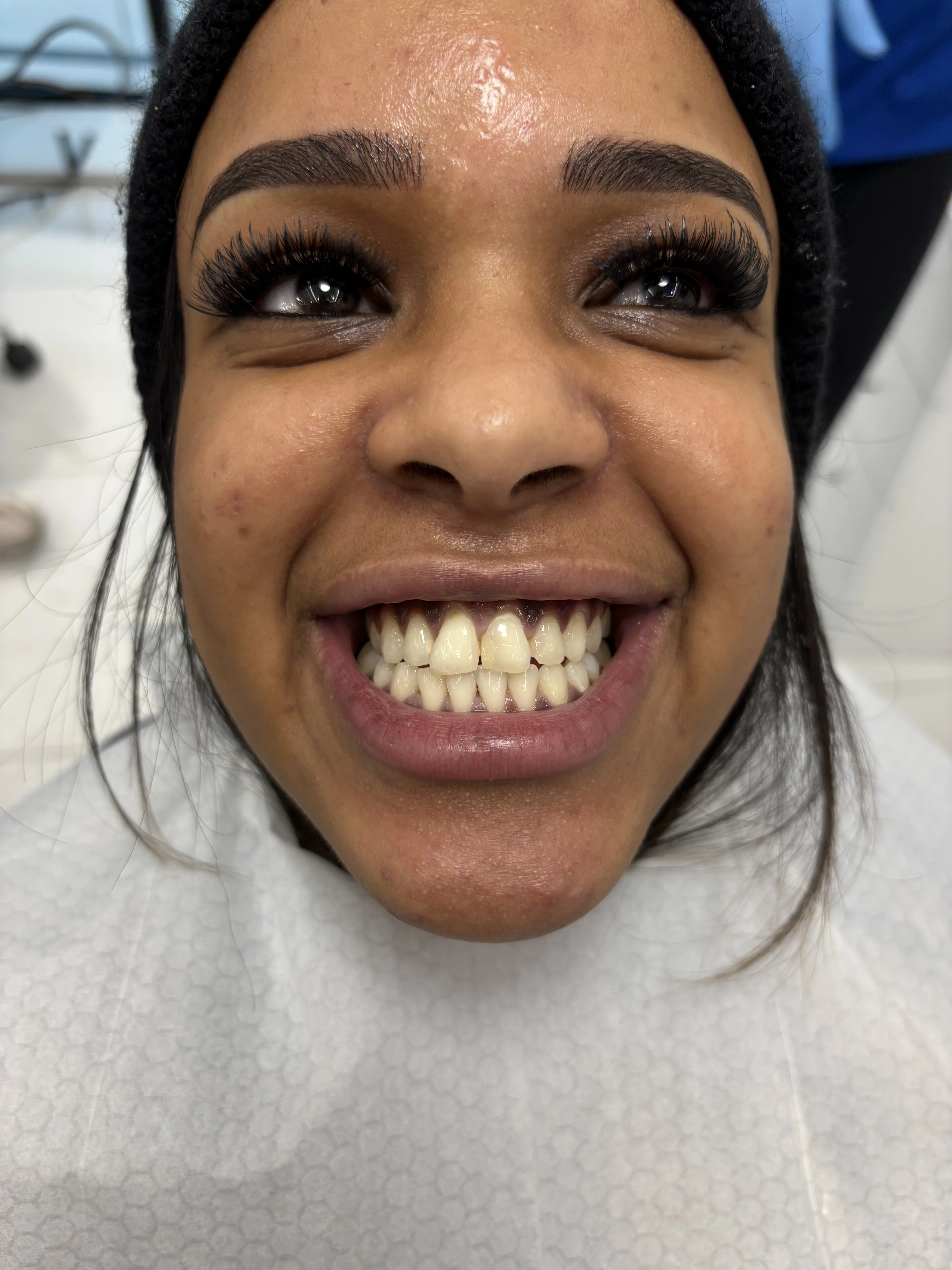 Composite bonding before case 18 — Istanbul
