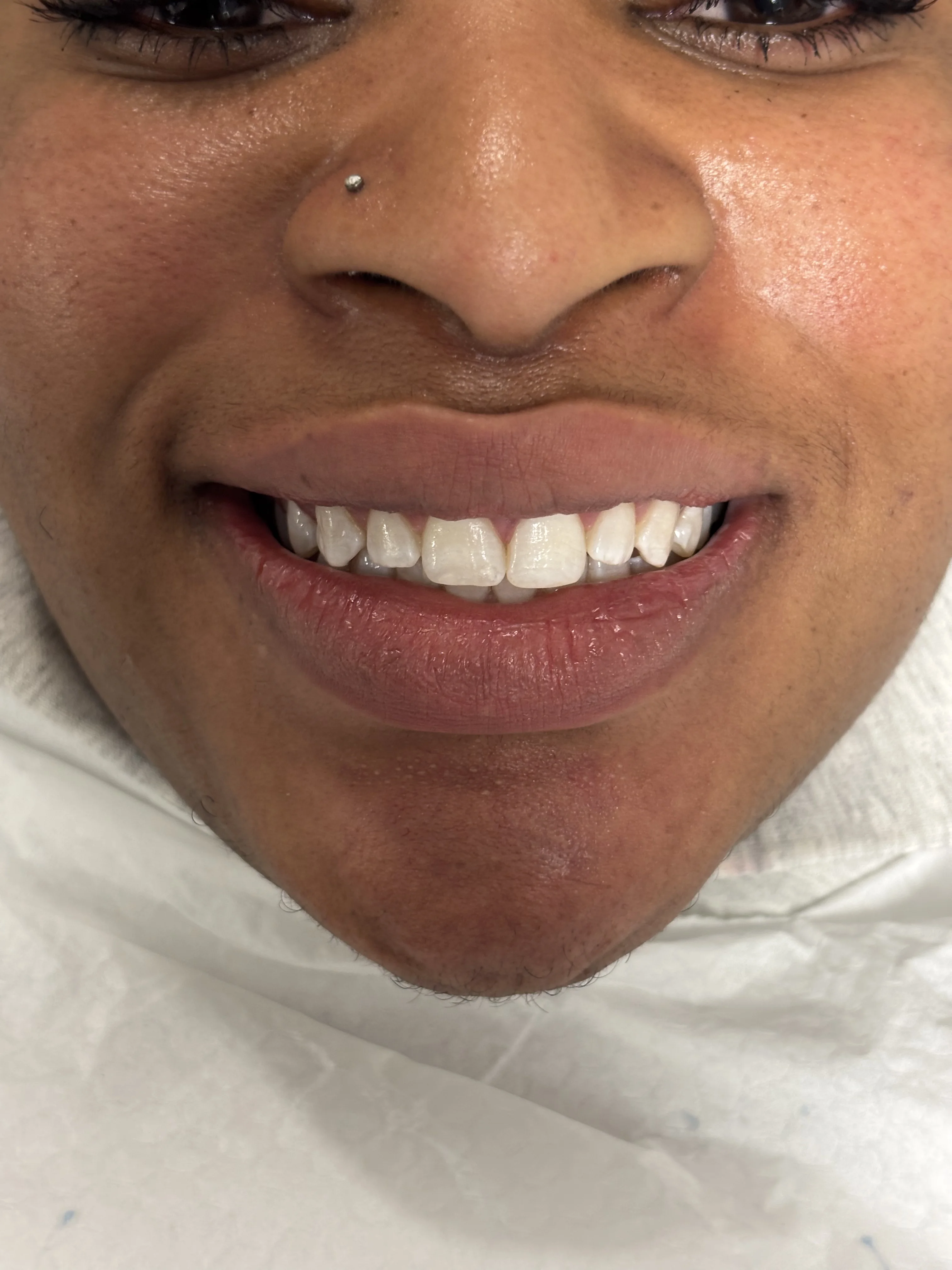 Composite bonding before case 19 — Istanbul