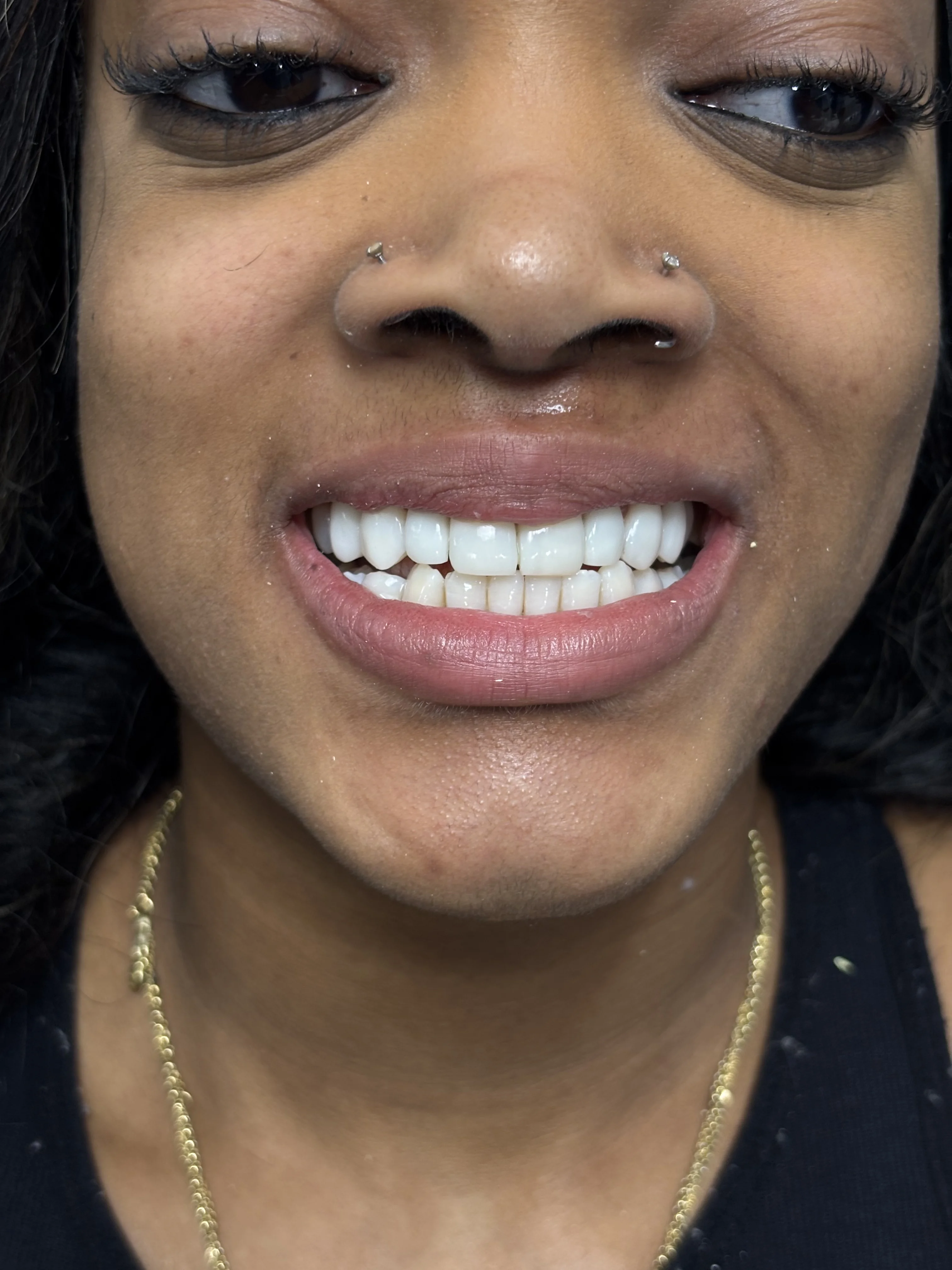 Composite bonding after case 20 — Istanbul NexWell