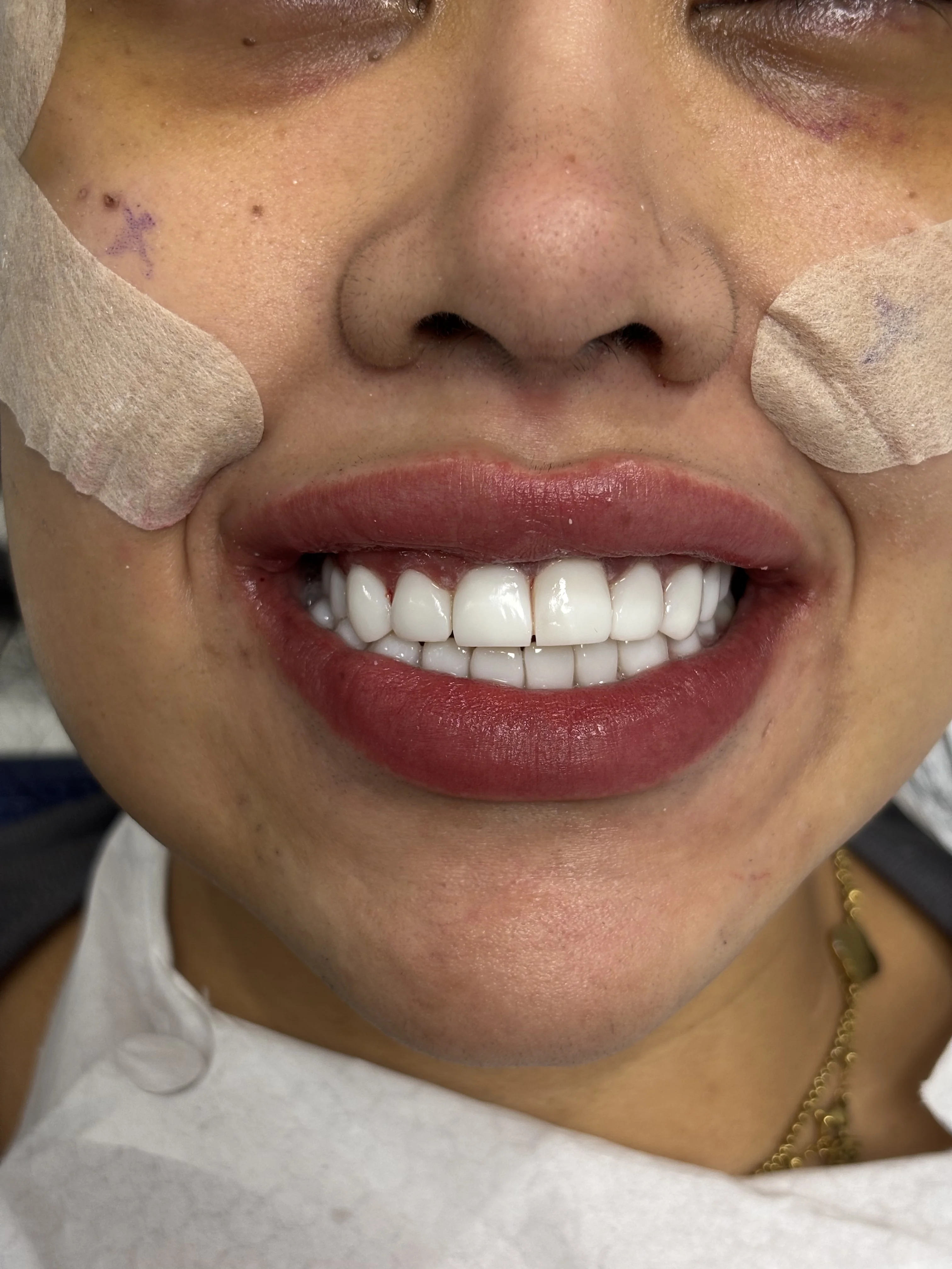Composite bonding after case 21 — Istanbul NexWell