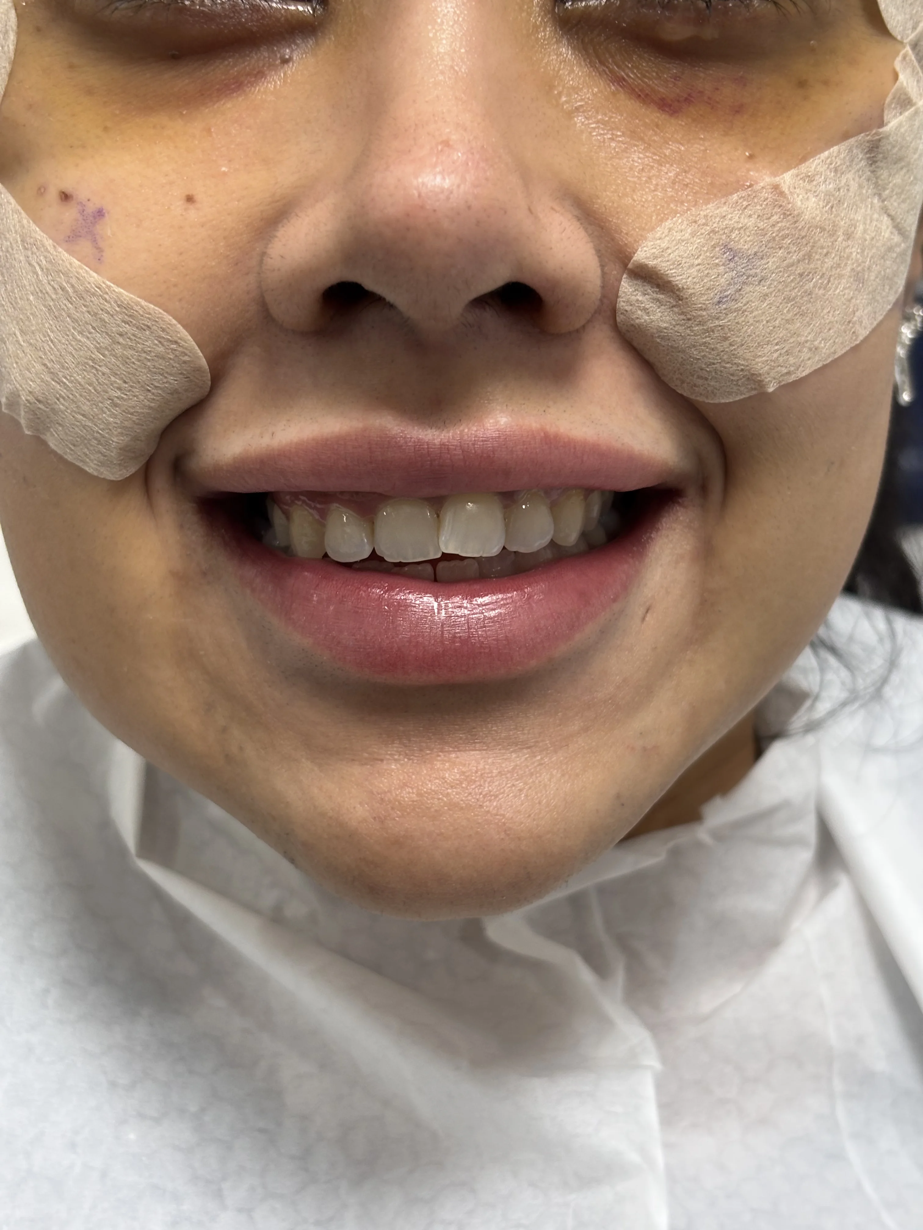 Composite bonding before case 21 — Istanbul