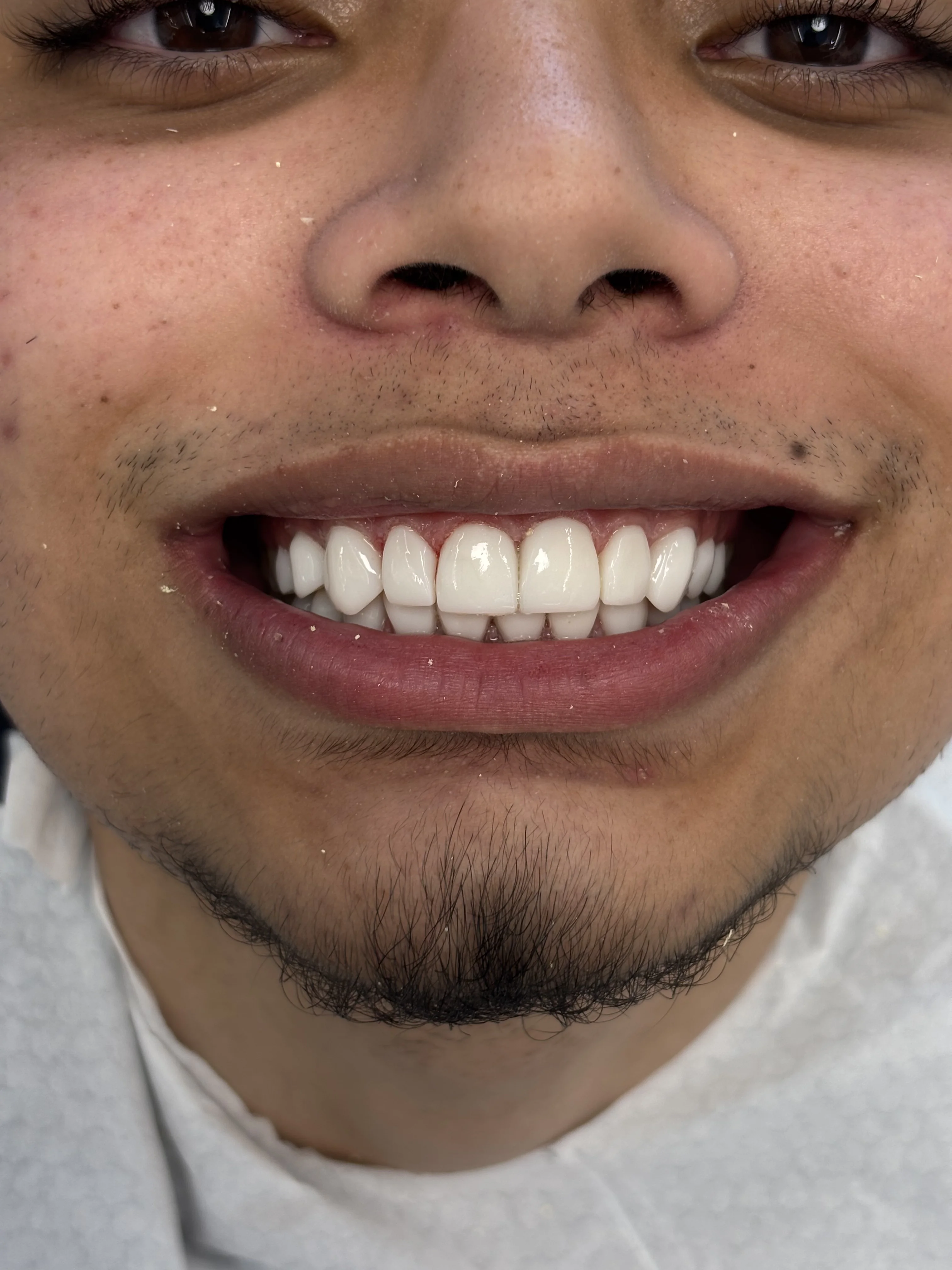 Composite bonding after case 22 — Istanbul NexWell