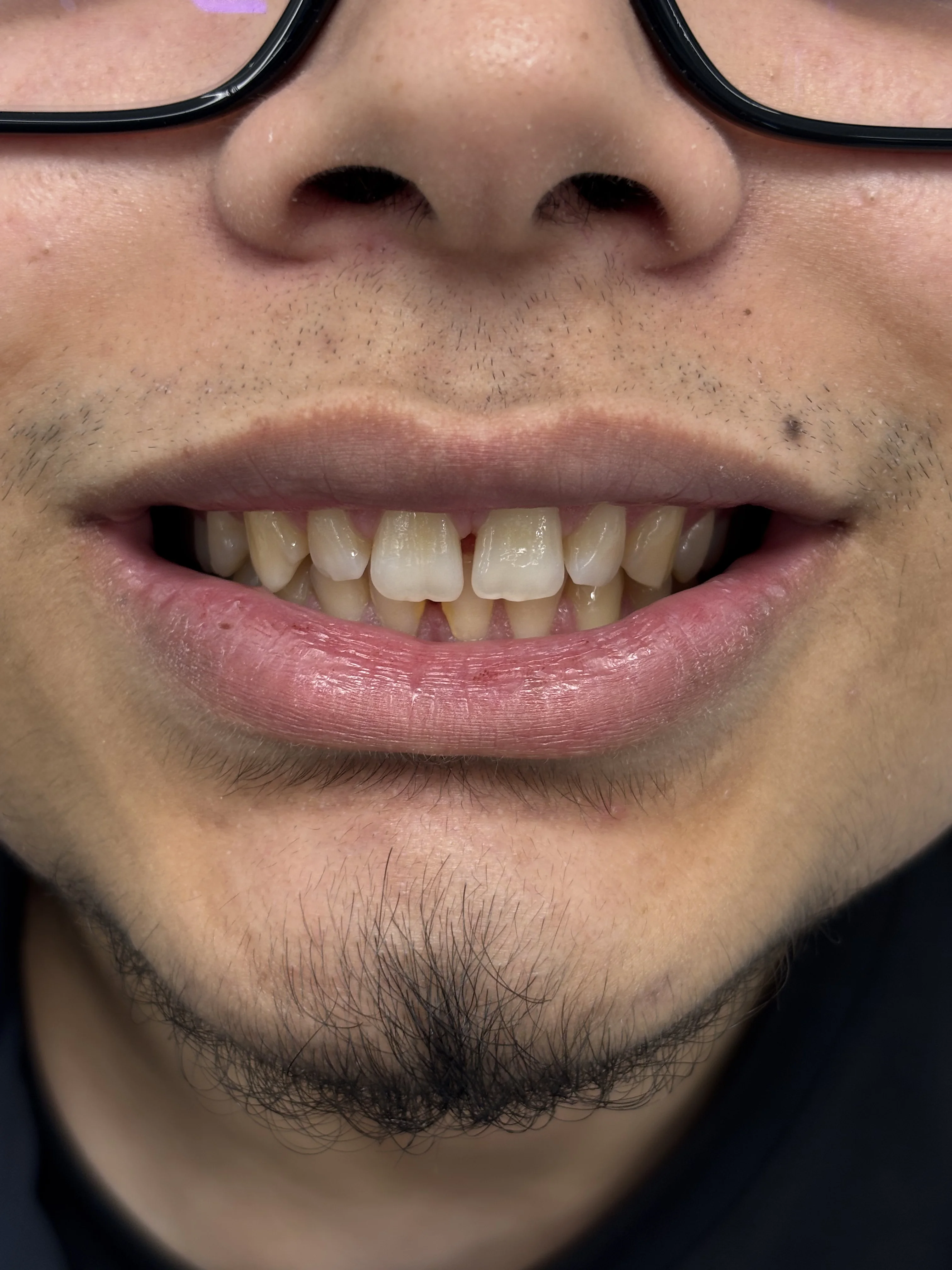 Composite bonding before case 22 — Istanbul