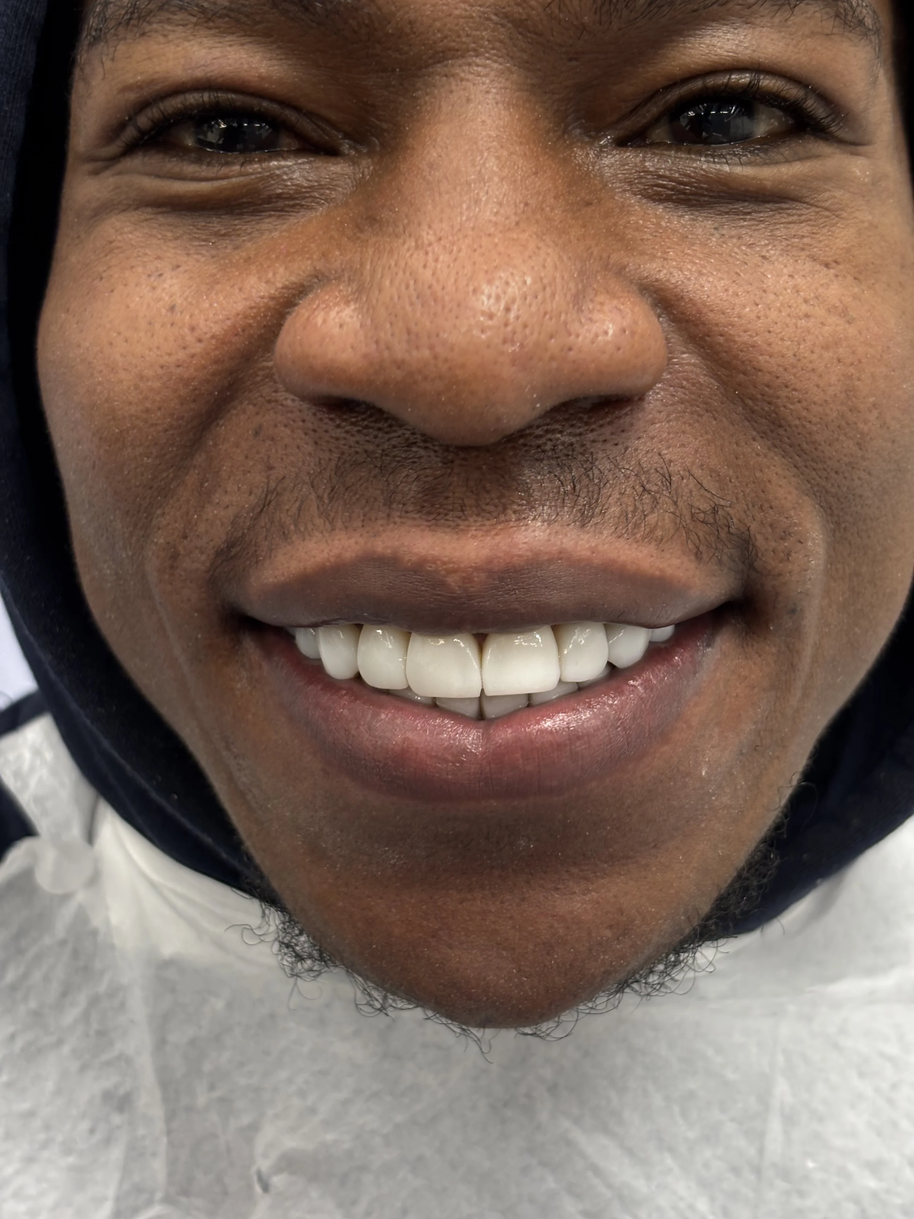 Composite bonding after case 23 — Istanbul NexWell