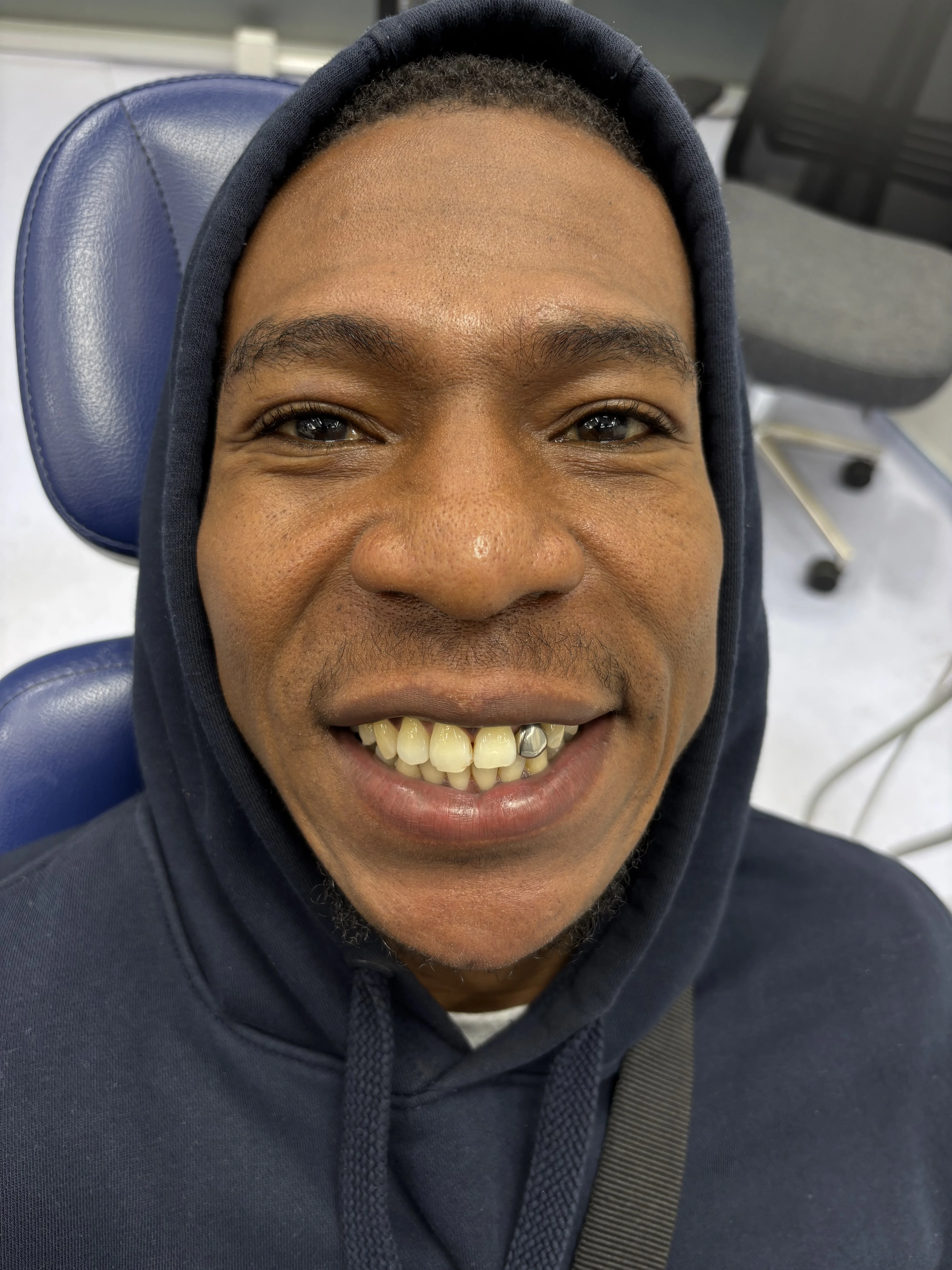Composite bonding before case 23 — Istanbul