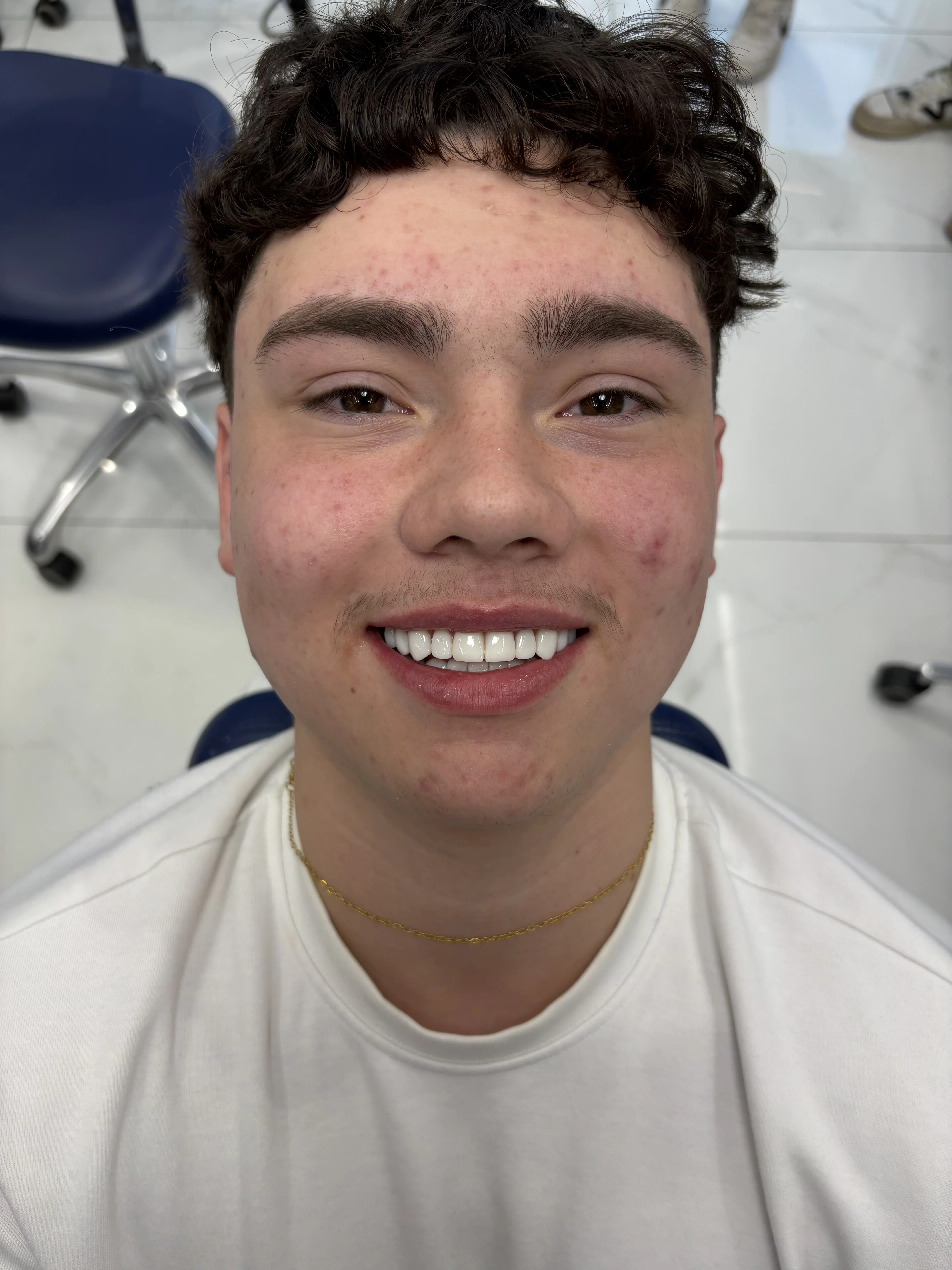Composite bonding after case 24 — Istanbul NexWell