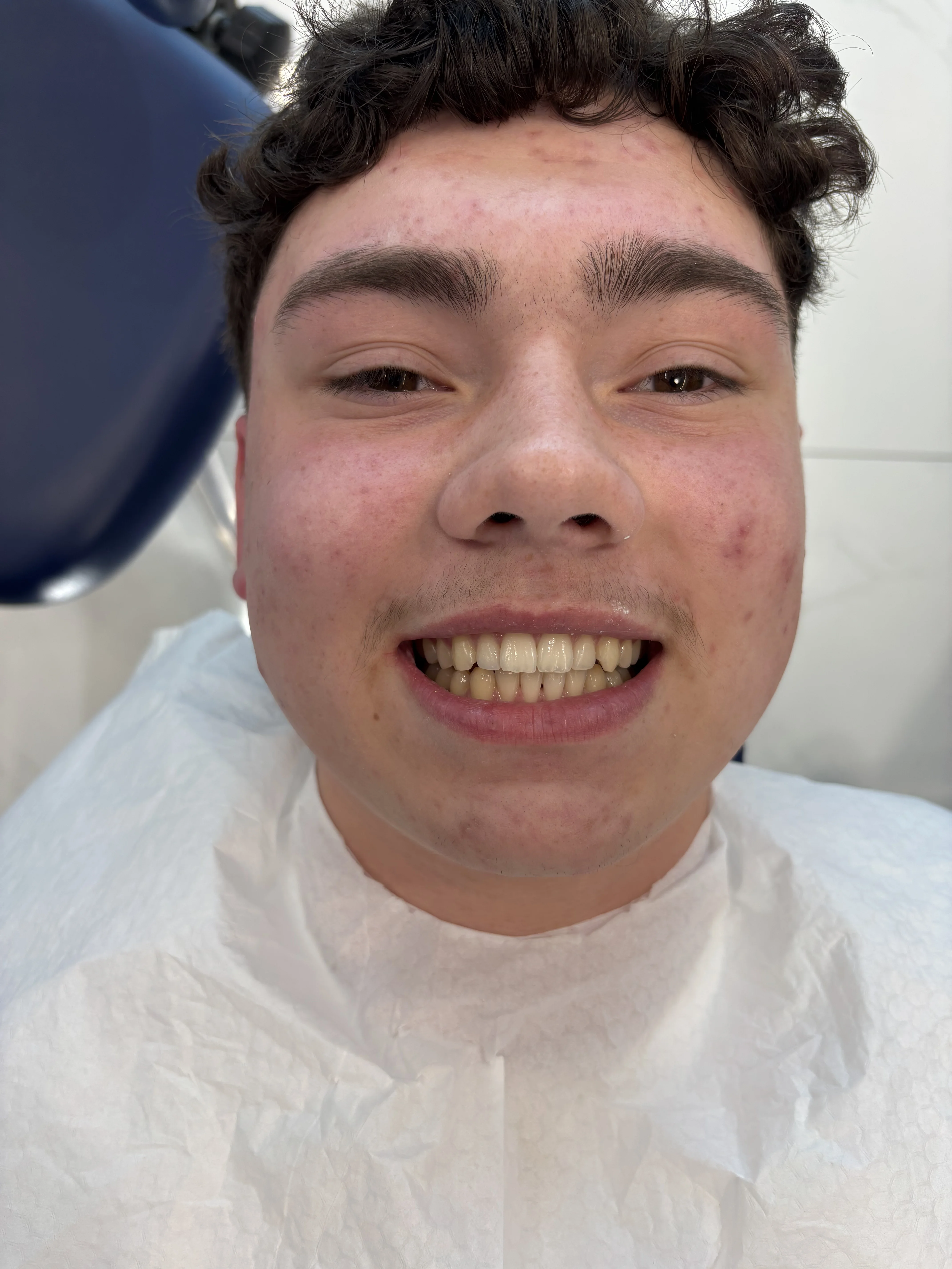 Composite bonding before case 24 — Istanbul