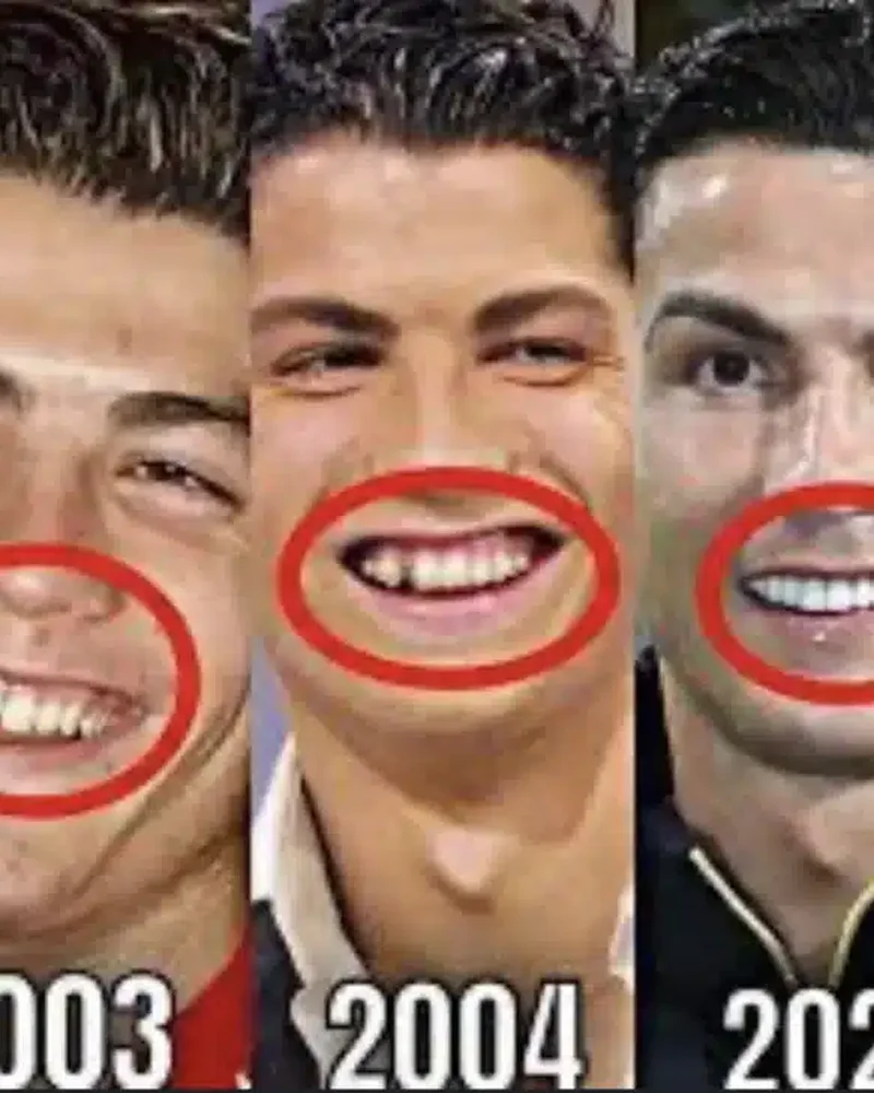 Cristiano Ronaldo Smile Makeover