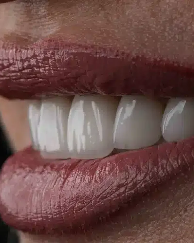 Hollywood Smile Concept