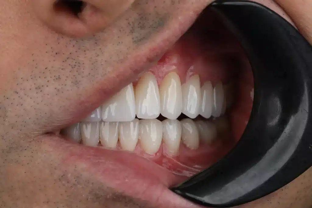 Close-up of a completed smile design result with veneers