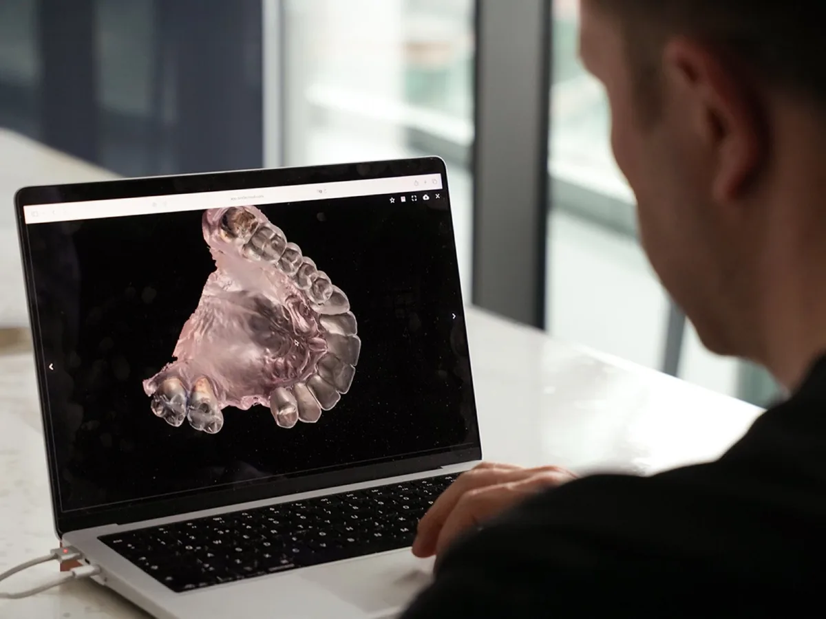 A 3D model of an upper jaw and prosthesis on a laptop during surgical planning