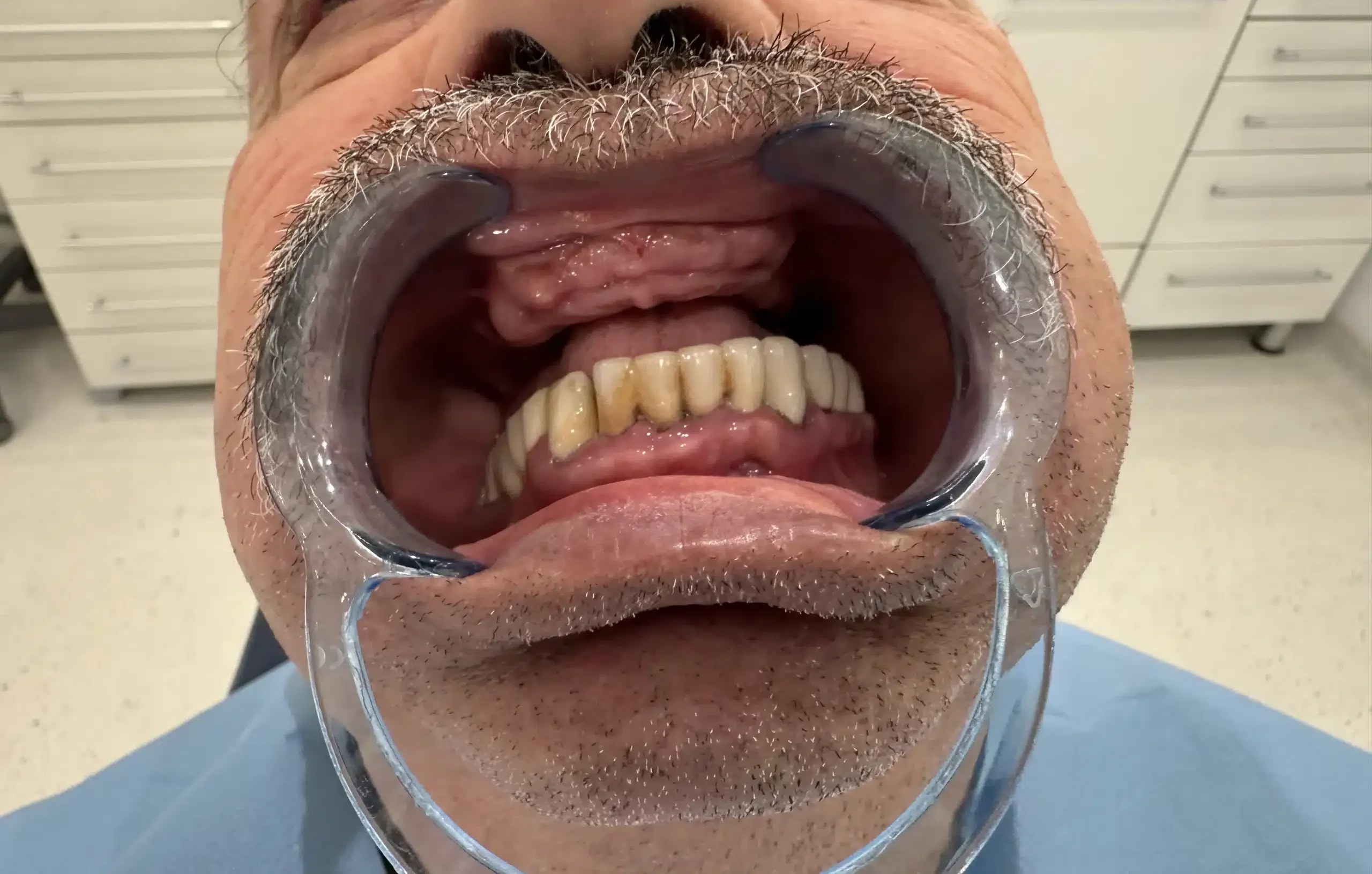 Dental implants in Istanbul clinic and travel planning guide