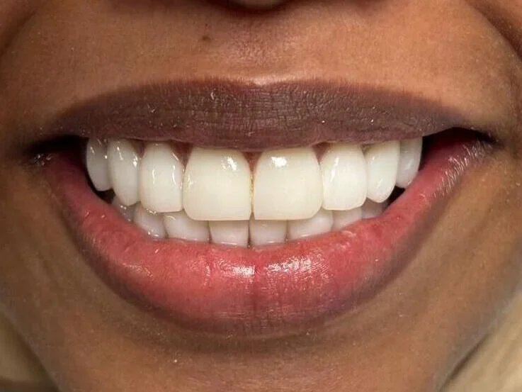 After — smile transformation, case-1