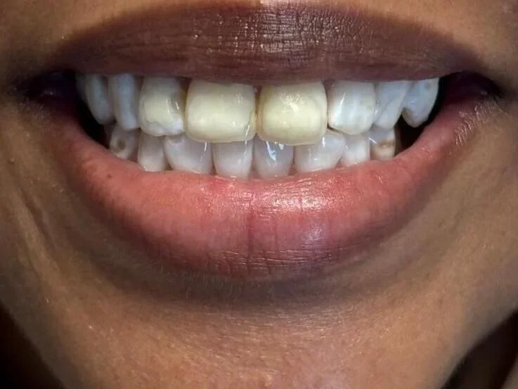 Before — smile transformation, case-1