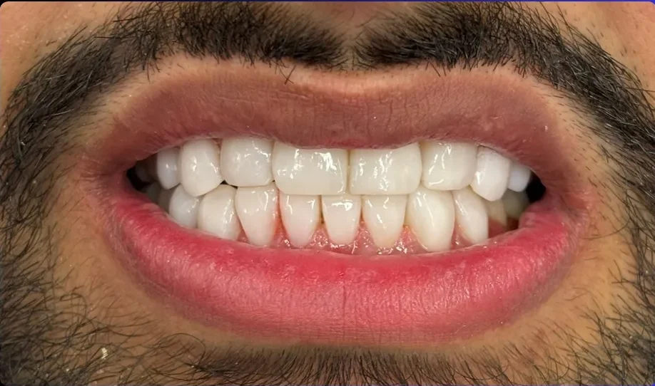 After — smile transformation, case-10