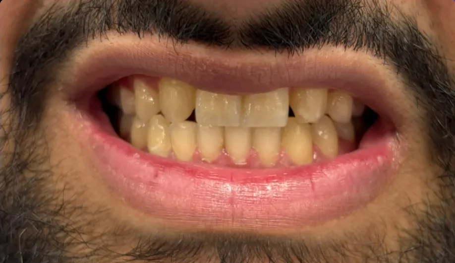 Before — smile transformation, case-10