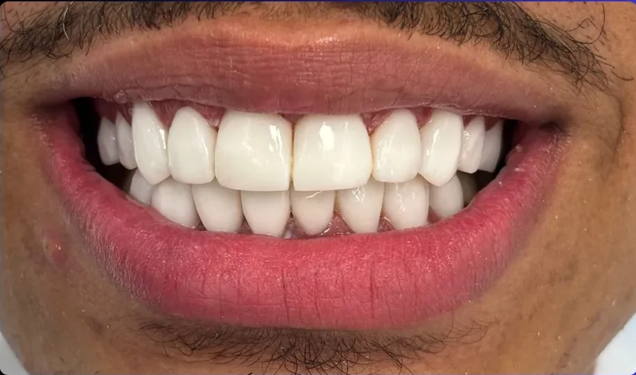 After — smile transformation, case-12