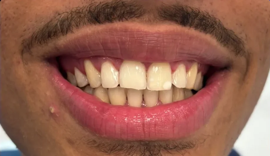 Before — smile transformation, case-12