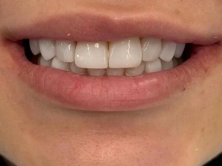After — smile transformation, case-13