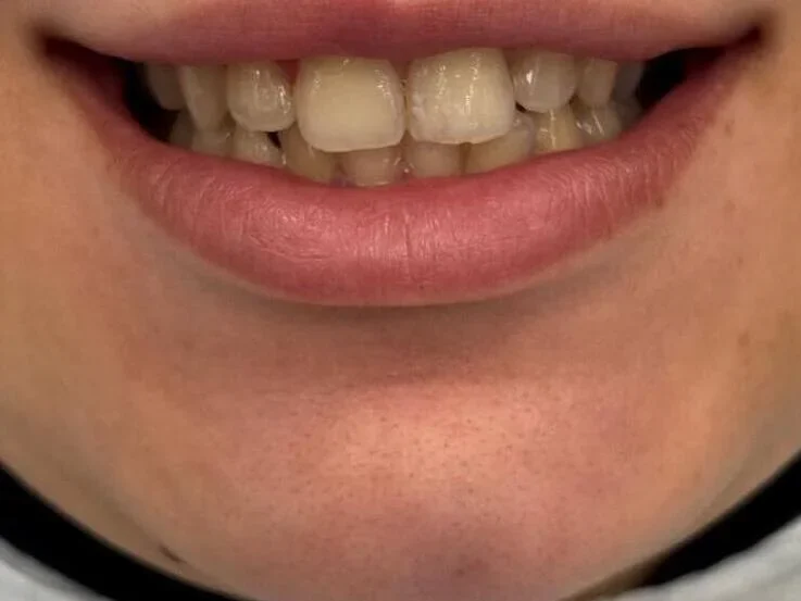 Before — smile transformation, case-13