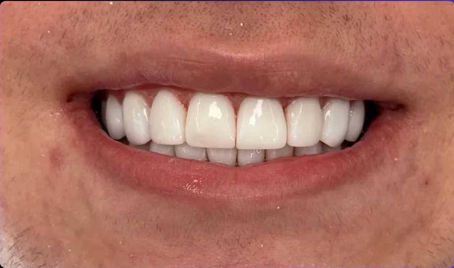 After — smile transformation, case-14