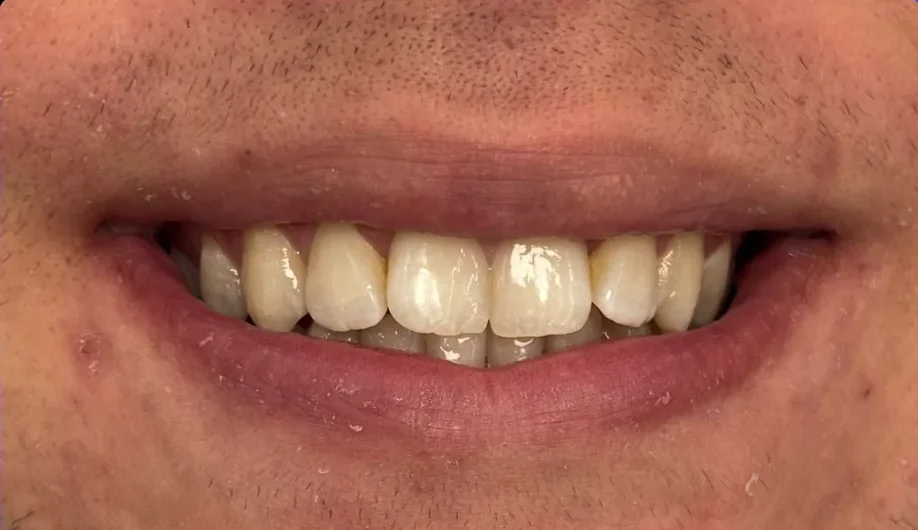 Before — smile transformation, case-14