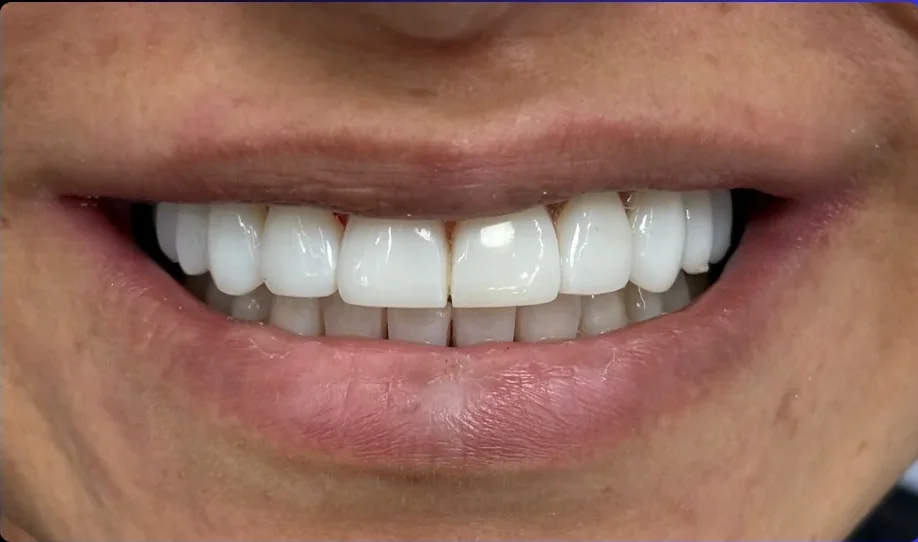 After — smile transformation, case-15