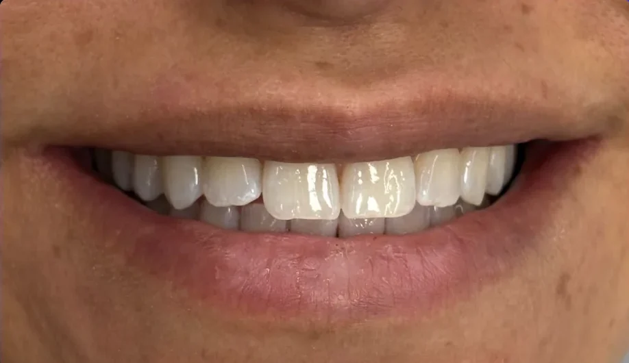 Before — smile transformation, case-15