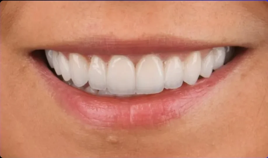After — smile transformation, case-16