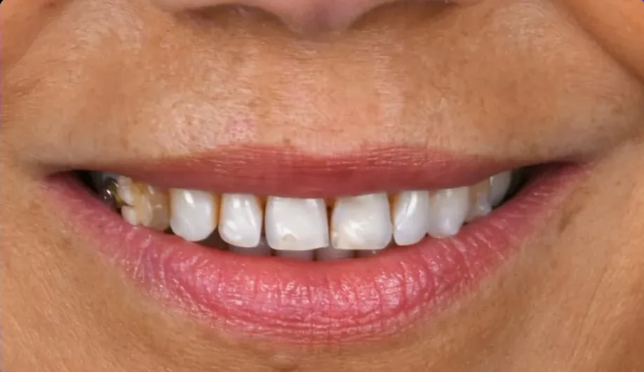 Before — smile transformation, case-16