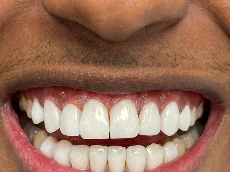 After — smile transformation, case-2