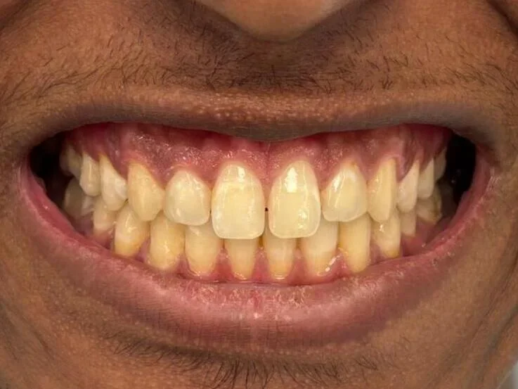 Before — smile transformation, case-2