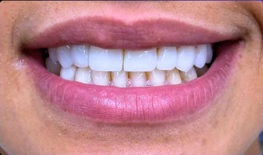 After — smile transformation, case-3