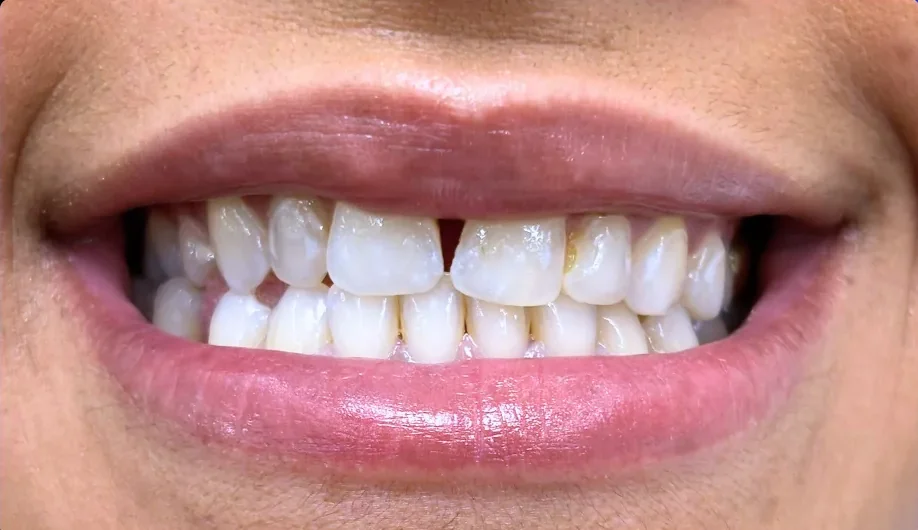 Before — smile transformation, case-3