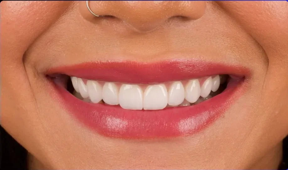 After — smile transformation, case-4