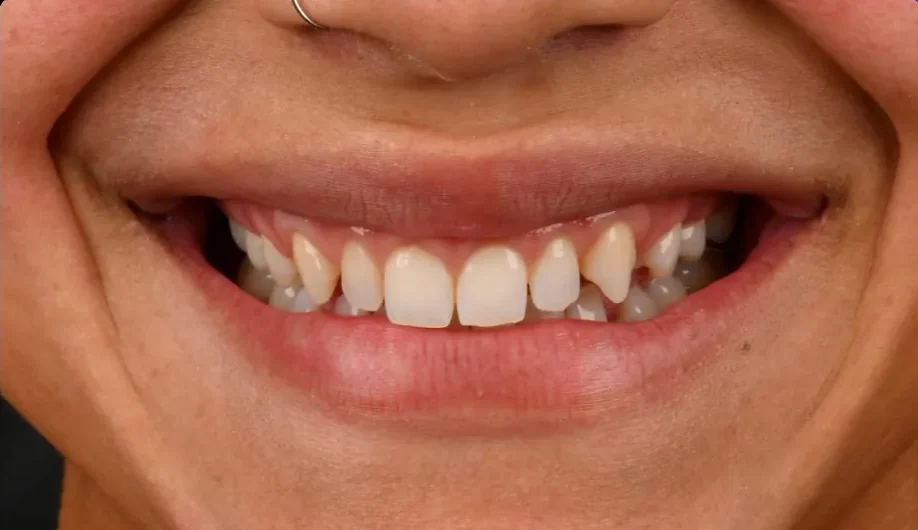 Before — smile transformation, case-4
