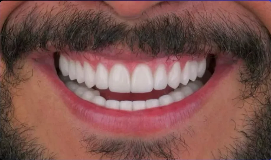 After — smile transformation, case-5