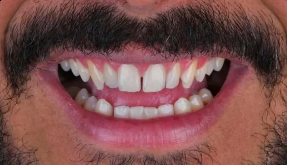 Before — smile transformation, case-5