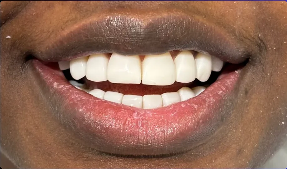 After — smile transformation, case-7
