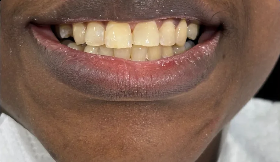 Before — smile transformation, case-7