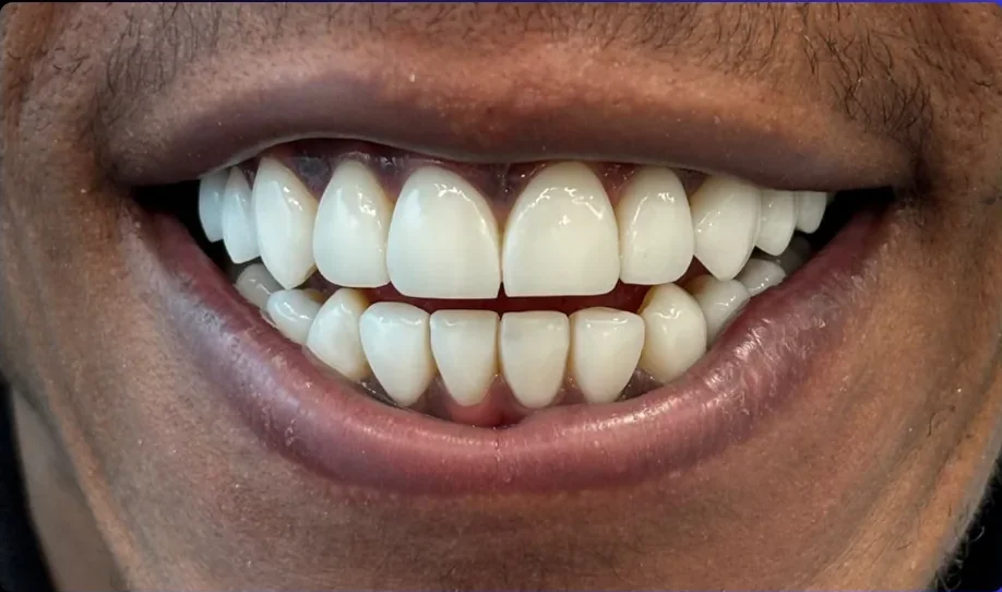 After — smile transformation, case-8