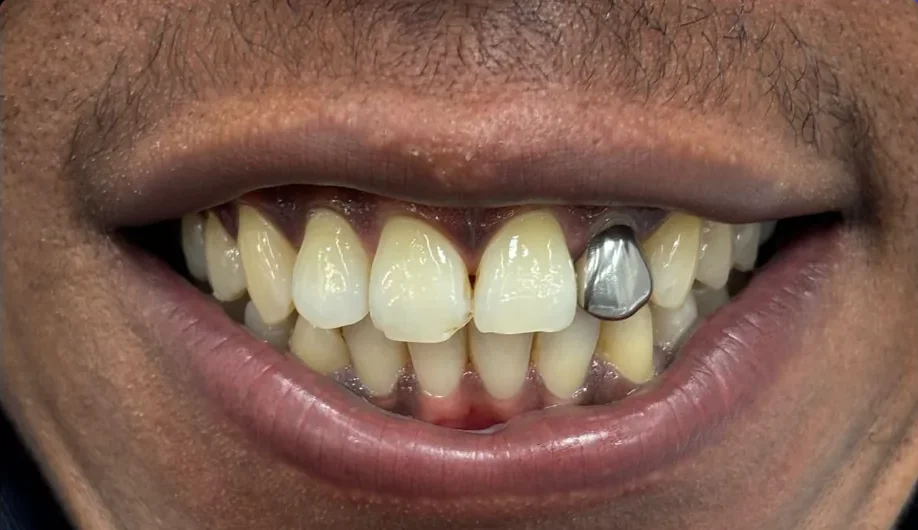 Before — smile transformation, case-8