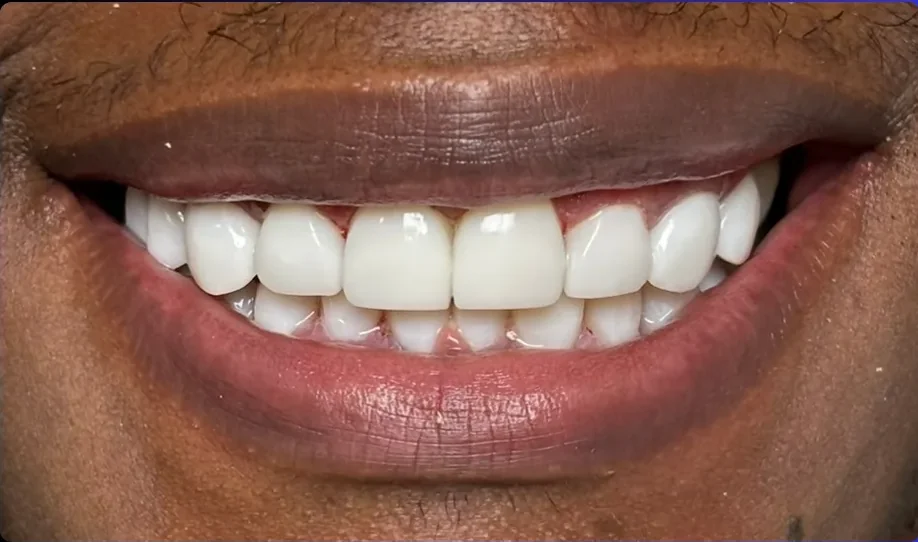 After — smile transformation, case-9