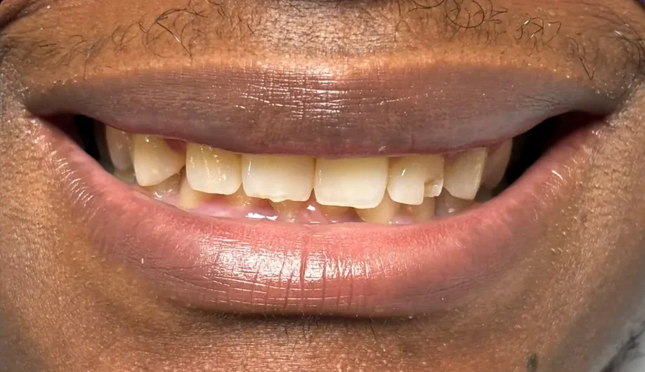 Before — smile transformation, case-9