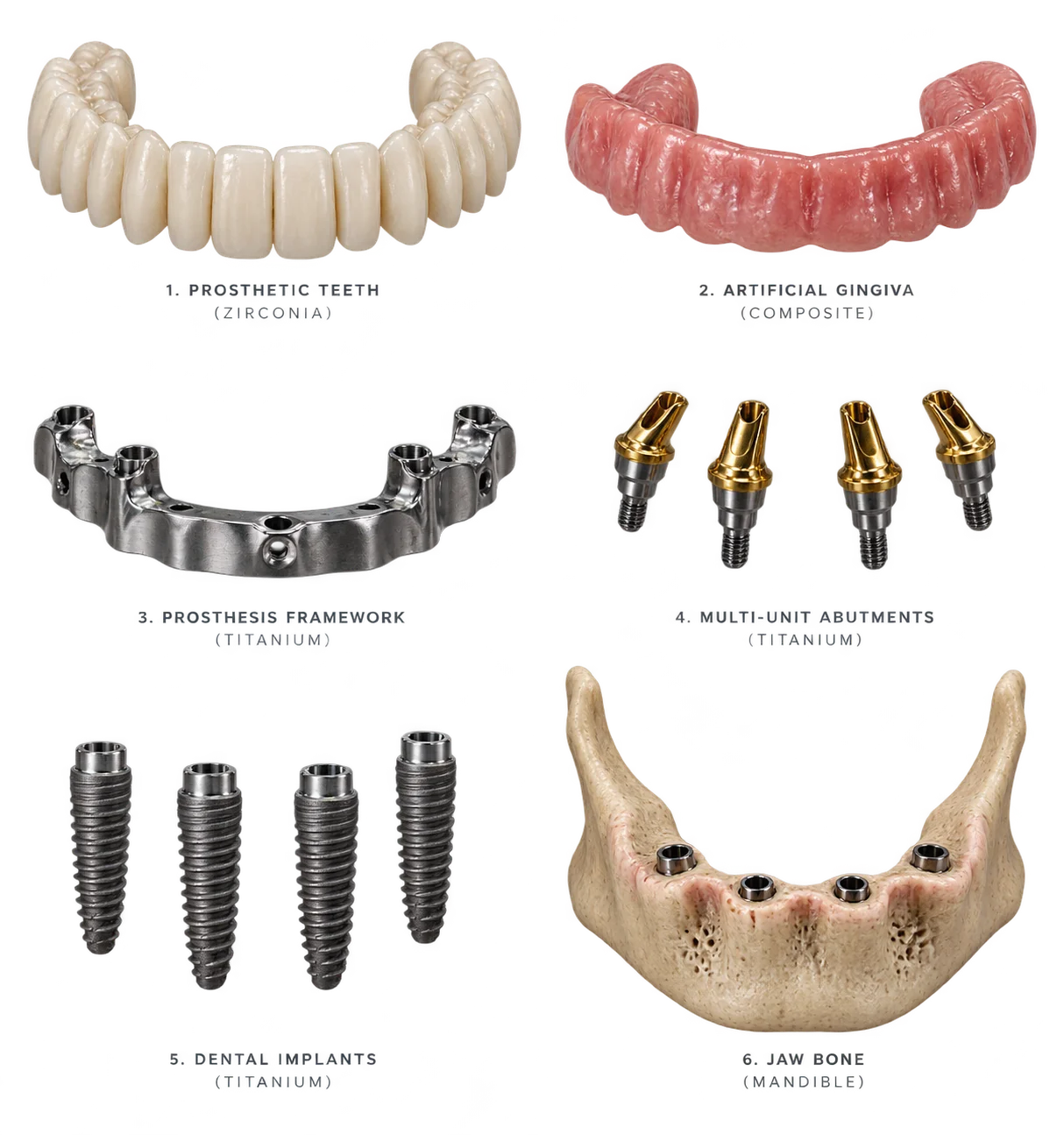Six components of a full-arch implant system labelled separately: zirconia prosthetic teeth, composite artificial gingiva, titanium prosthesis framework, titanium multi-unit abutments, titanium dental implants and jaw bone